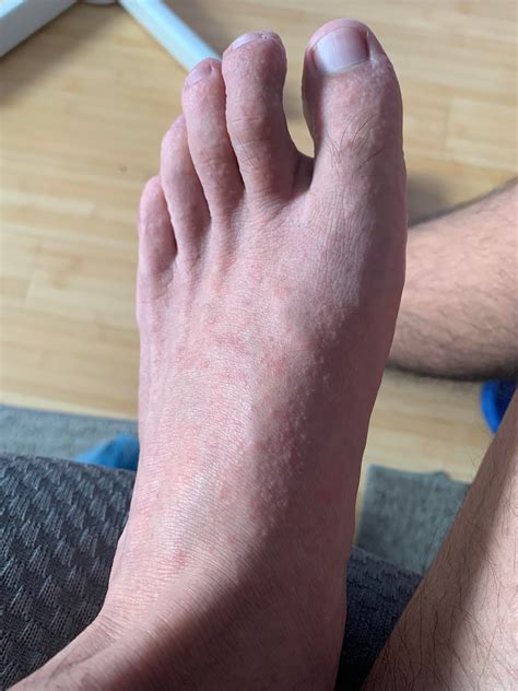Dyshidrotic eczema? Rash on feet and hands slowly spreading to arms and