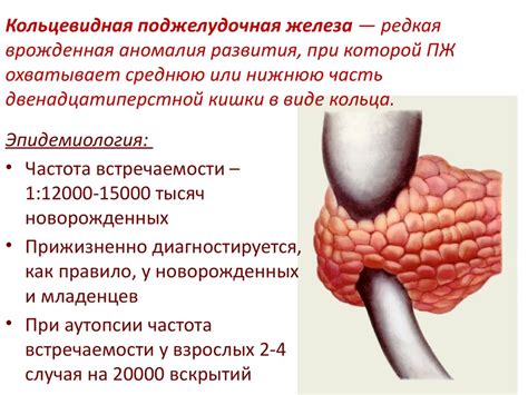 Поджелудочная железа. Аномалии развития (добавочная и кольцевидная ...