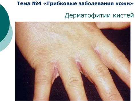 Грибковые поражения - online presentation