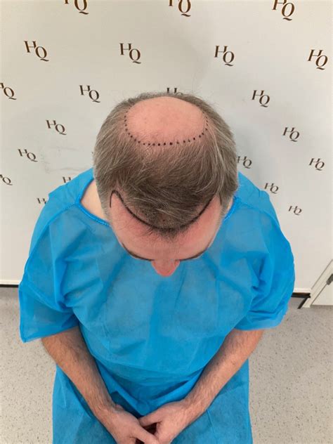 Amazing review for life changing results - HQ Hair Transplants