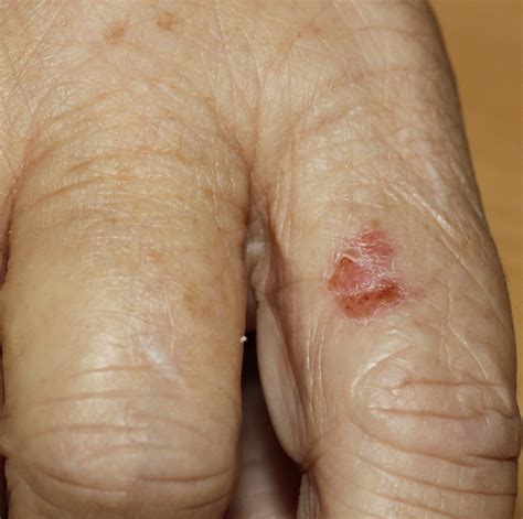 SCC in Situ: Key Information