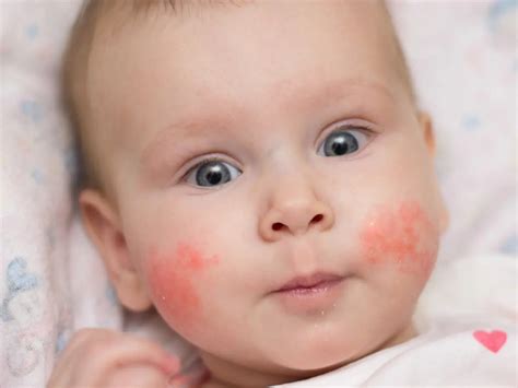 penyebab ruam  kulit bayi menurut dokter   mengatasinya