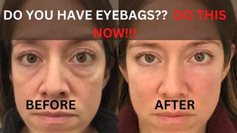 Why Do I Have Puffy Bags Under My Eyes When I Wake Up at Alice Fisher blog