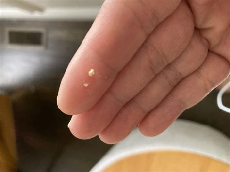 What is this coming out of eye? Appears as little white balls on eyes