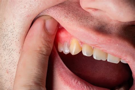 amoxicillin  tooth infection lifemd