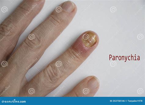 Paronychia Disease of the Fingernail Painful Healing Painful Problem ...