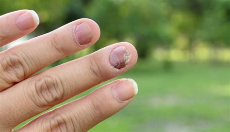 Onycholiza paznokcia – co to właściwie za choroba? - Transplantacja.org.pl