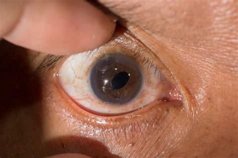 The Disease Of Eye Cataracts