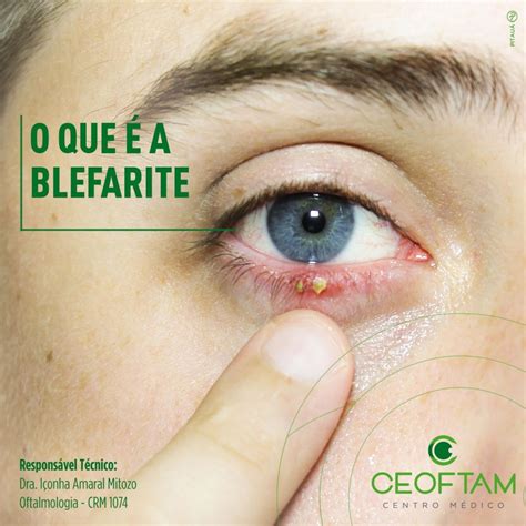 O Que Causa Blefarite - O que é Blefarite ? - CEOFTAM Centro Médico