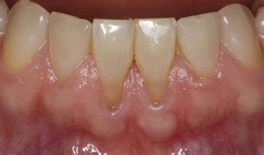 mucogingival definition  mucogingival