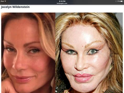 Worst Celeb Plastic Surgery