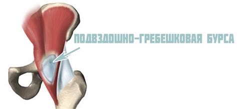 Бурсит тазобедренного сустава симптомы и лечение