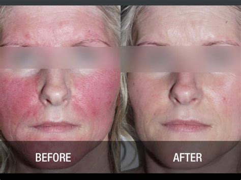 laser treatment  rosacea swelling  kenton bridges blog