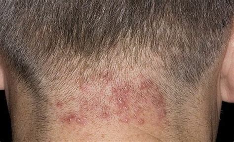 Способы лечения келоидных рубцов - Coolaser Clinic