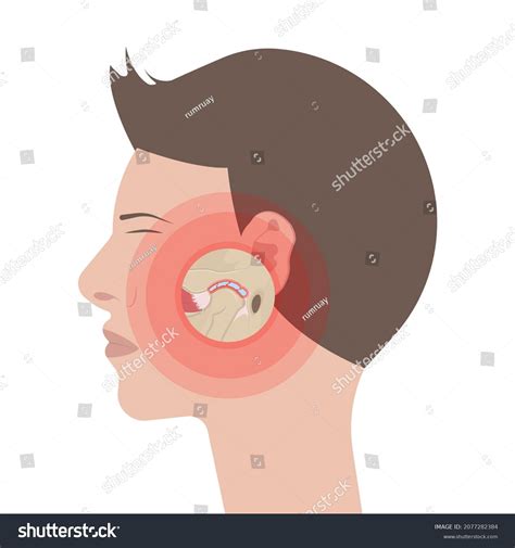Temporomandibular Joint Disorders Tmd Tmj Treat Stock Vector (Royalty