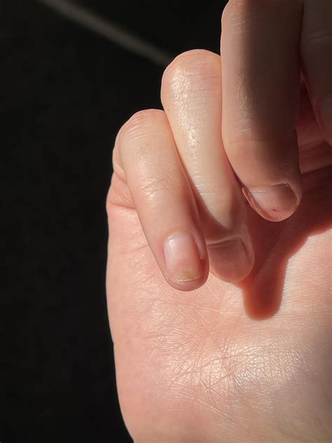 Whats under my nail 😭 : r/DermatologyQuestions