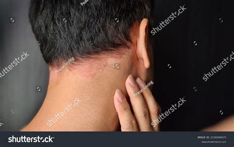 Psoriasis Skin Disease Causes Rash Itchy Stock Photo 2236096975 ...