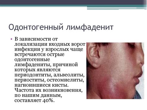 Лимфаденит - презентация онлайн