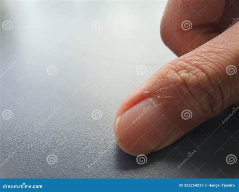 Close-up Photo of a Hand Showing the Thumb Nails and the Skin Around ...