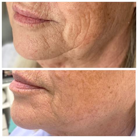 Уред за лифтинг за лице ORION | Facecare
