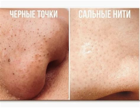 Не путайте черные точки с сальными нитями! В чем их разница и как от ...