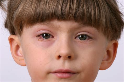 Conjuntivitis primaveral o vernal - AVER