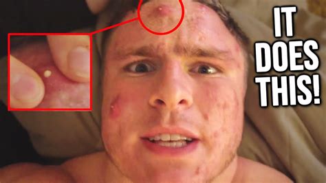WHAT HAPPENS WHEN YOU POP A PIMPLE (DAY BY DAY) - YouTube