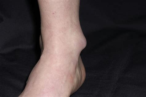 Bursitis Of The Ankle Photograph by Dr P. Marazzi/science Photo Library