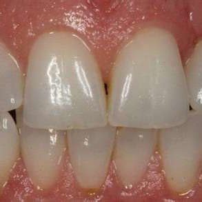 cementation  final crown  scientific diagram