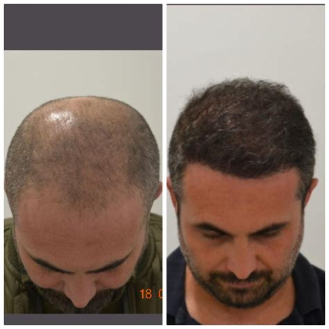 how much is hair transplant in turkey