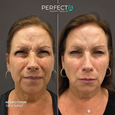 Neurotoxin Treatment - Perfect B