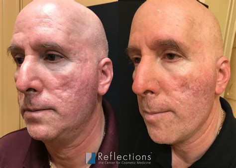 Bacne Scars Treatment