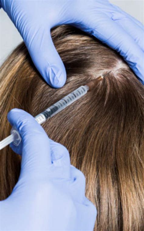PRP For Hair Loss Treatment - Revitalis