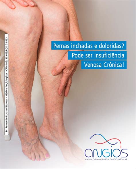 Pernas Doloridas E Inchadas