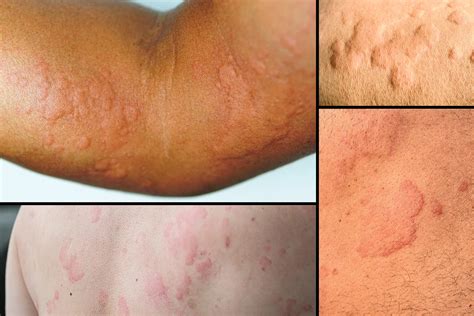 surprising   hives revealed    triggering  skin