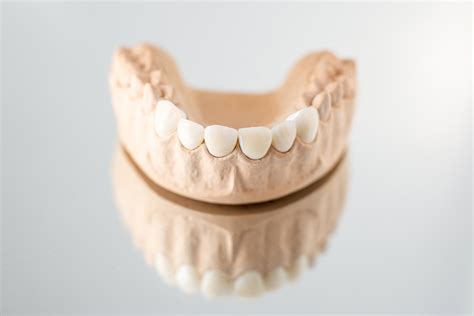veneers      hollywood smile porcelain veneers sydney