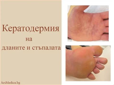 Висока пикочна киселина – причини | ArsMedica.bg