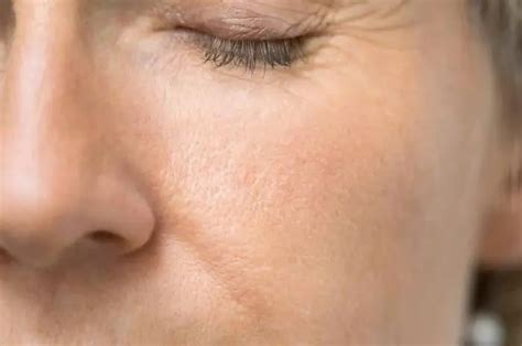 Holes in the skin: causes and treatment. How to get rid of post-acne ...