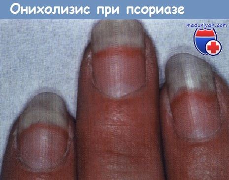 Отслоение ногтевой пластинки при болезнях