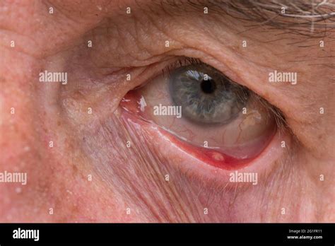 eye cyst     stye    lid stock photo alamy