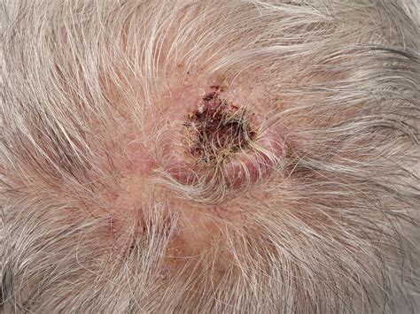Well differentiated squamous cell carcinoma - Stock Image - C050/7406