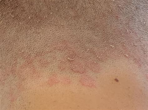 pimple on head under hair