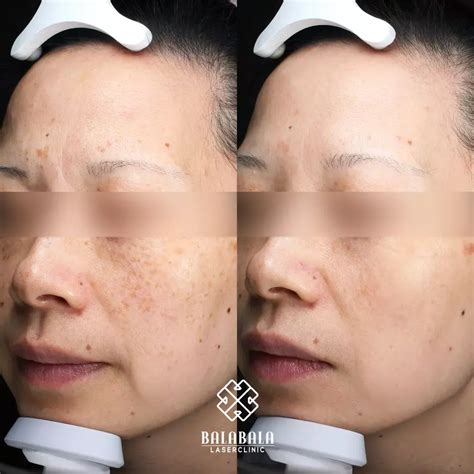 PicoSure Laser Treatment In Adelaide | BalaBala