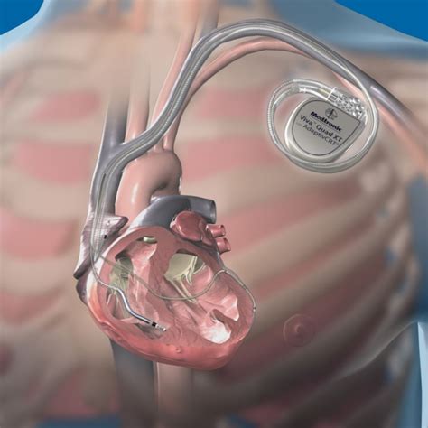 dual chamber pacemaker kartik heart centre