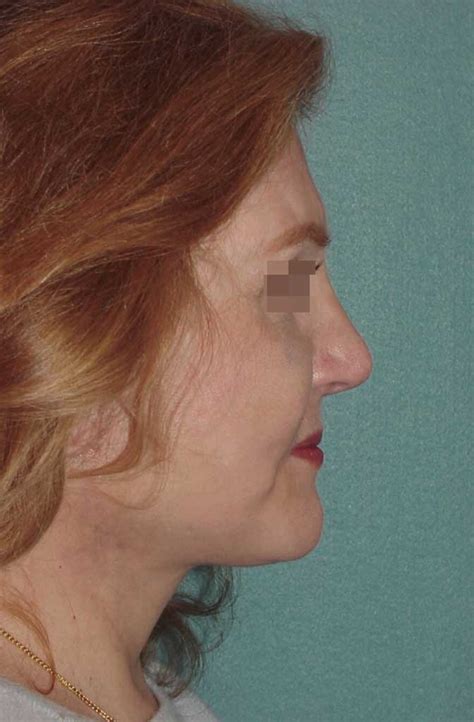 Neck Lift 1 - Robert A. Guida, MD, PC