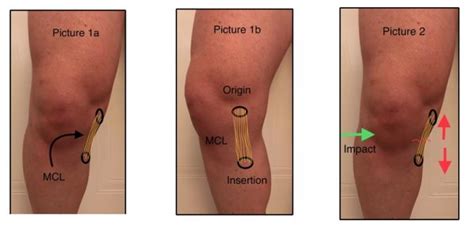 Physiotherapy spotlight: Knee MCL tears/ sprains | All For One