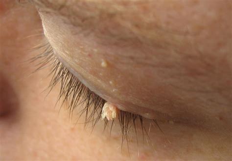 Filiform warts: What they look like, treatment, and causes
