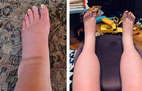 What to do if your legs are swollen during pregnancy – Healthy Food Near Me