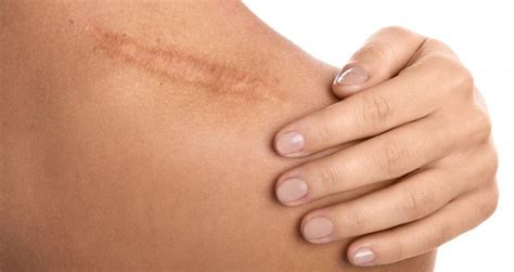 Understanding Why You Get Scars on Your Skin: Eliot Y. Ghatan, MD ...