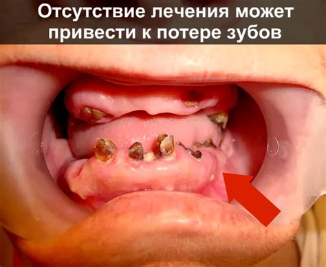 Почему гниет зуб | Взубе.ком